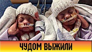 Недоношенные девочки-близняшки, родившиеся с «дырой» в пищеводе, чудом выжили