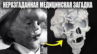 Как Человек Слон Бросил Вызов Всей Медицине